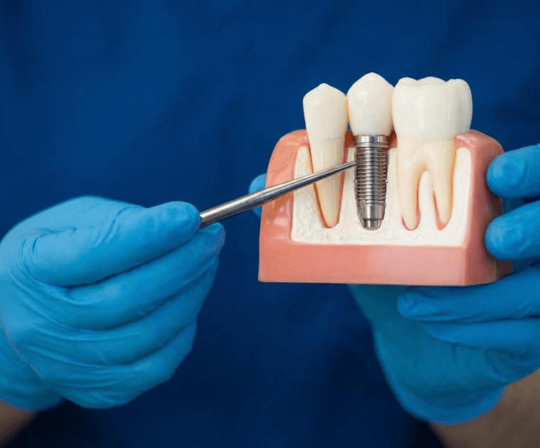 Dental Implants highlight at Miso Dental Care